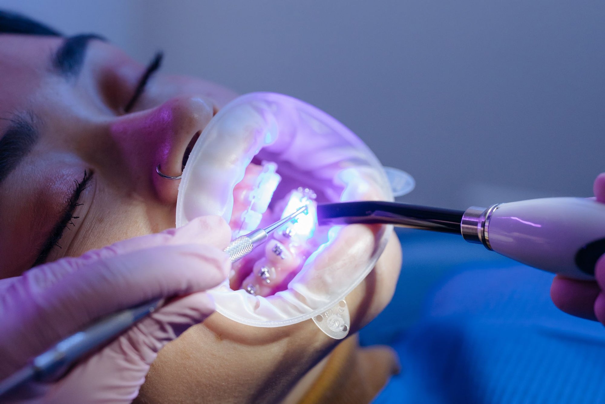 Unlocking the Potential of Optragate: Enhancing Dental Procedures