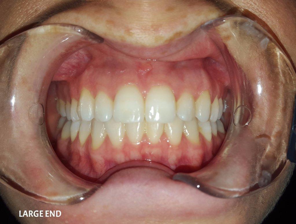 Plastic Double-Ended Cheek Retractor - Large