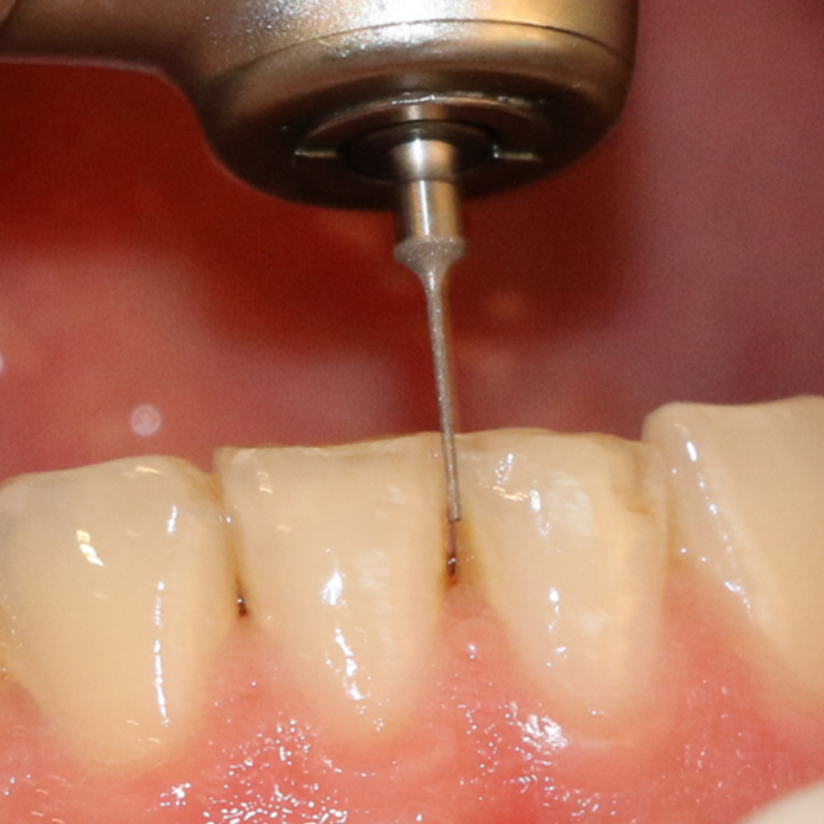 IPR Fine Bur in mouth