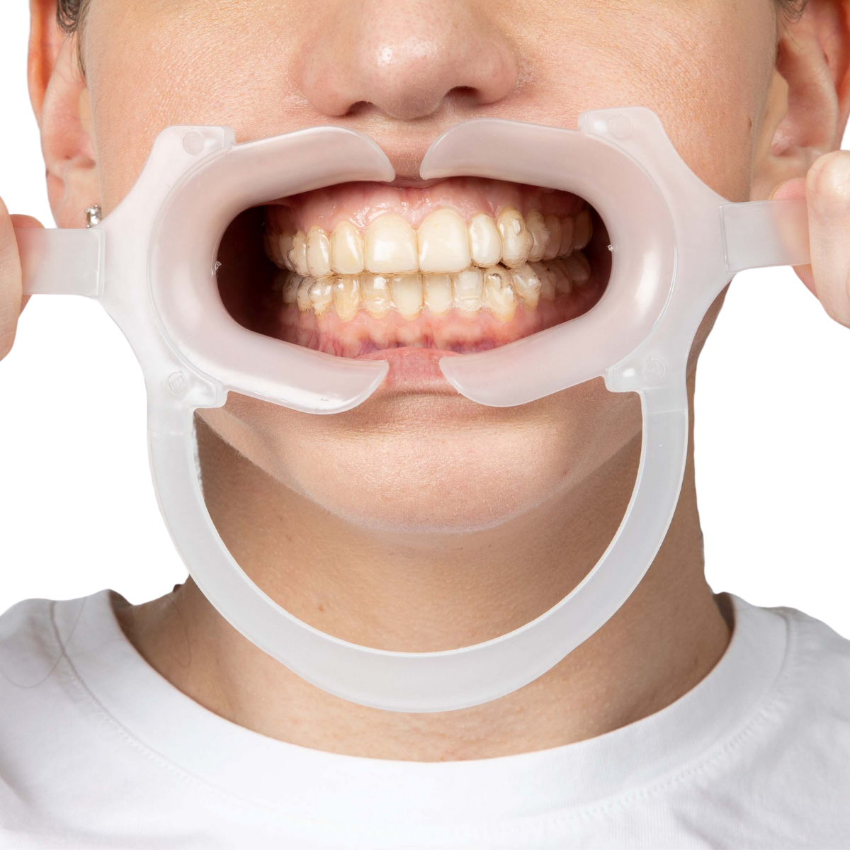 Hands Free Retractor in the mouth